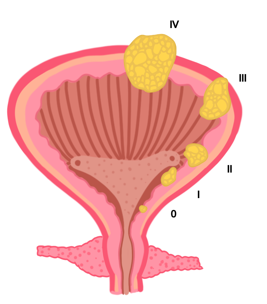 Bladder carcinoma