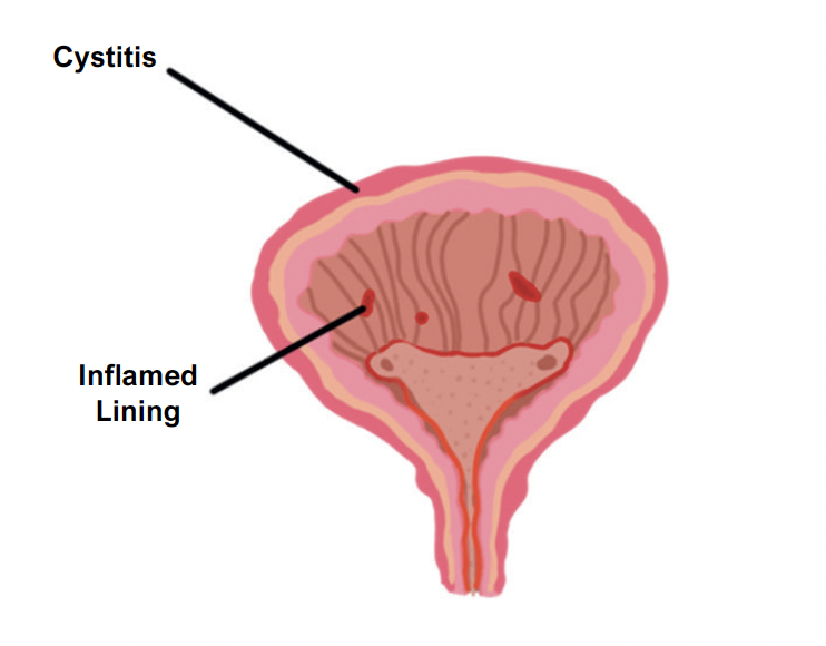 Cystitis