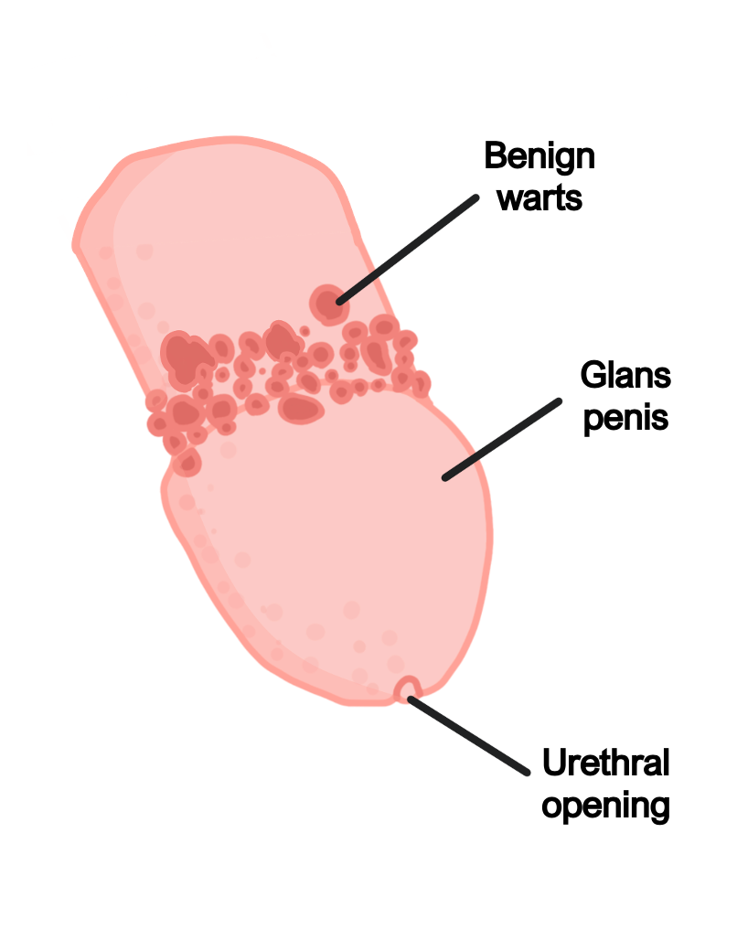 Genital warts