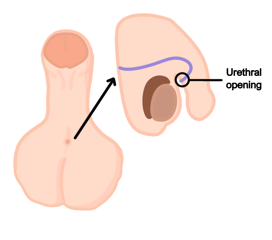 Hypospadius