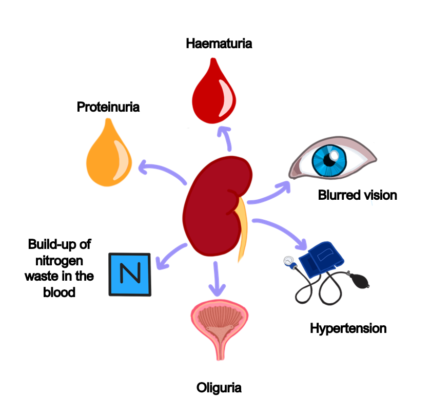 Nephritic syndrome