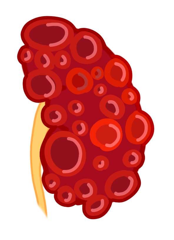 Polycystic kidney disease