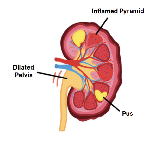 Pyelonephritis