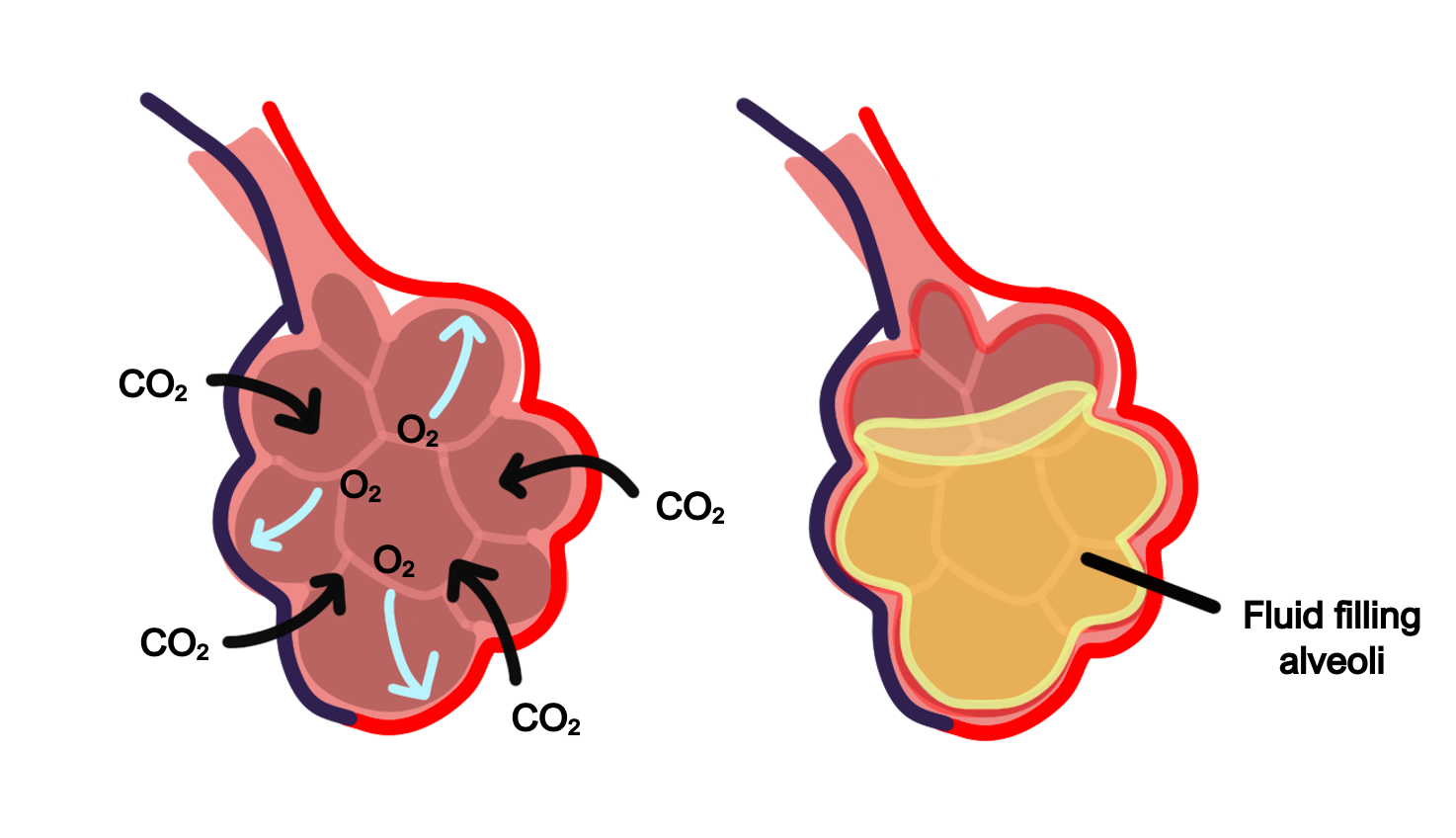 ARDs Acute respiratory distress syndrome