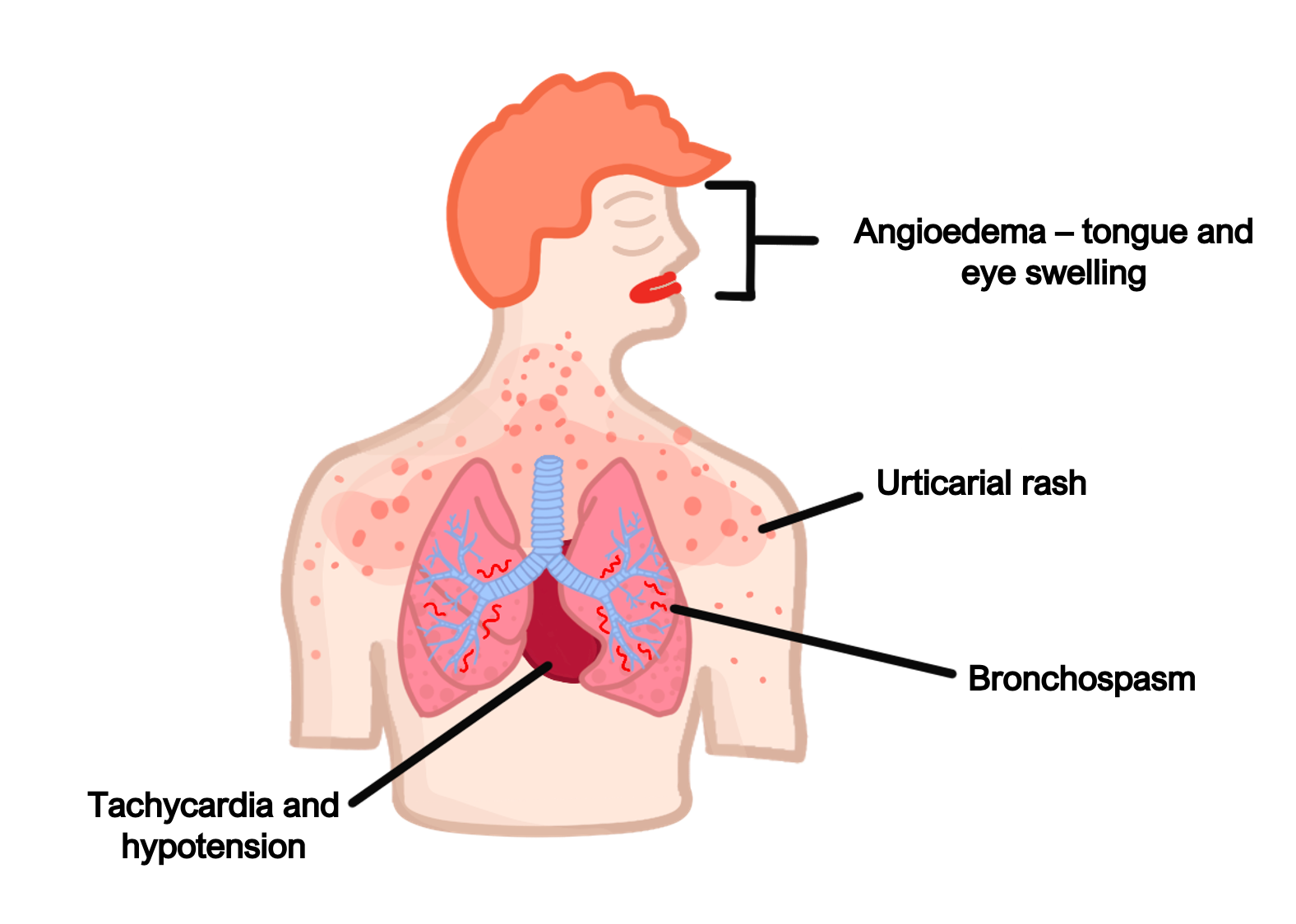 Anaphylaxis