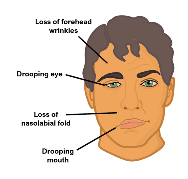 Bells' palsy Bell's palsy