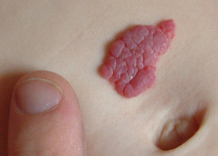 Capillary_haemangioma