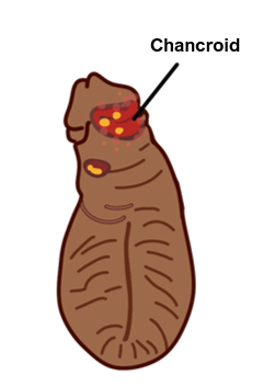 Chancroid