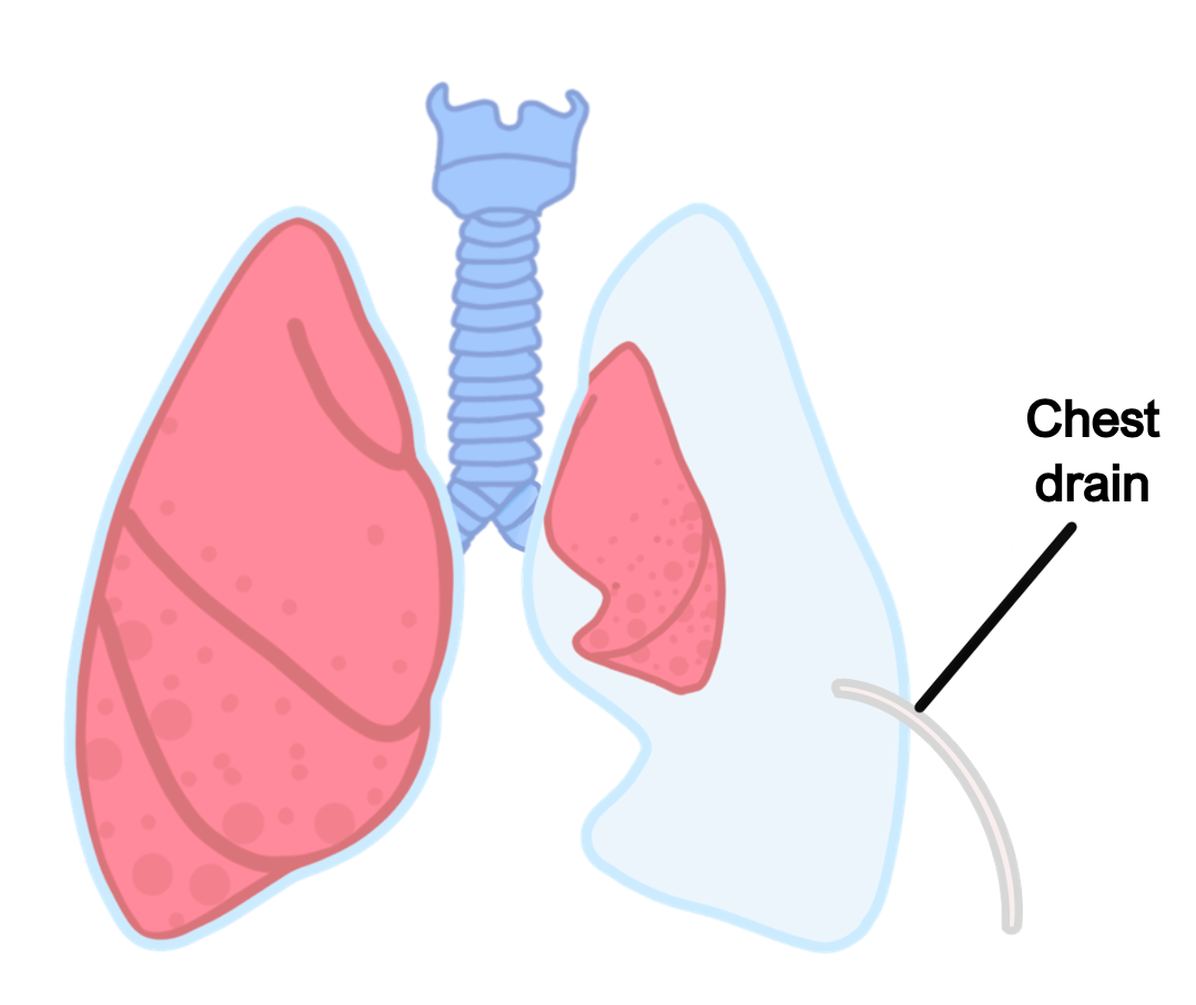 Chest drain (1) pneumothorax