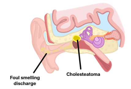 Cholesteatoma Cholesteatoma
