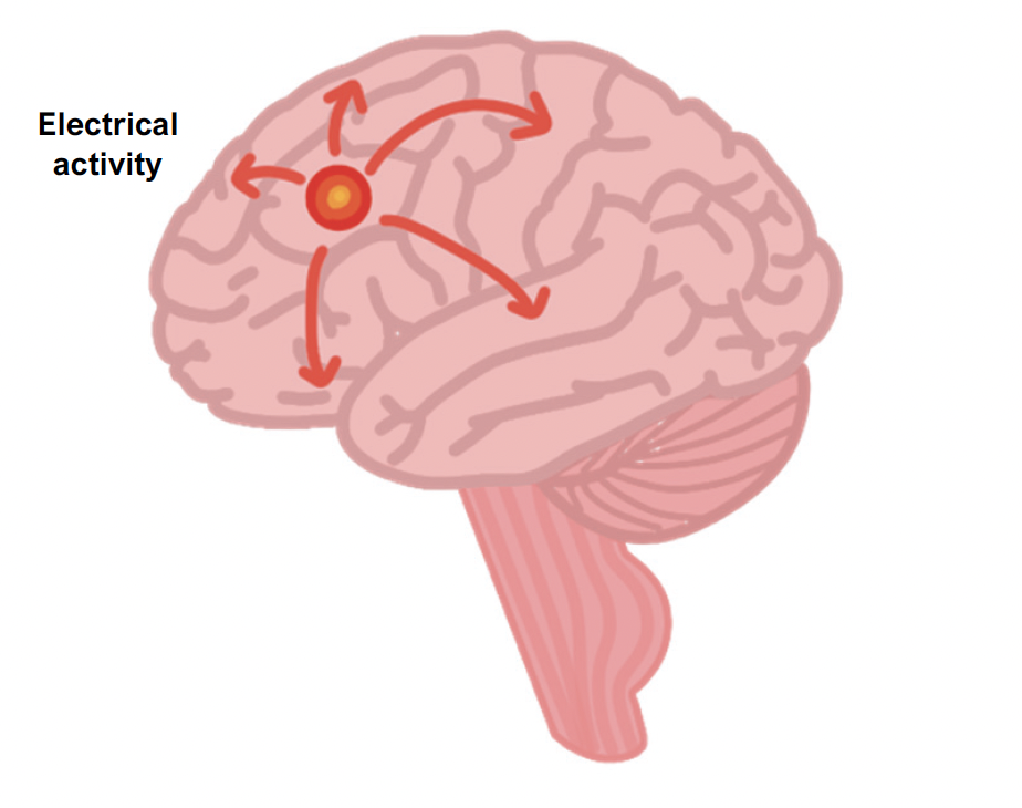 Epilepsy