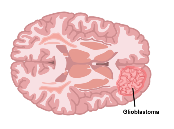 Glioblastoma glioblastoma multiforme