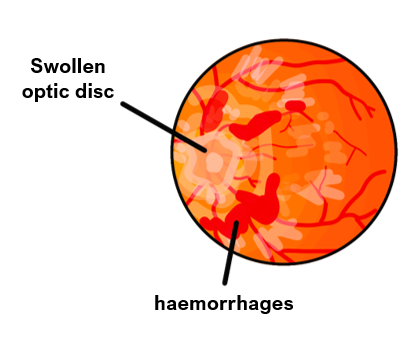 Idiopathic intracranial hypertension