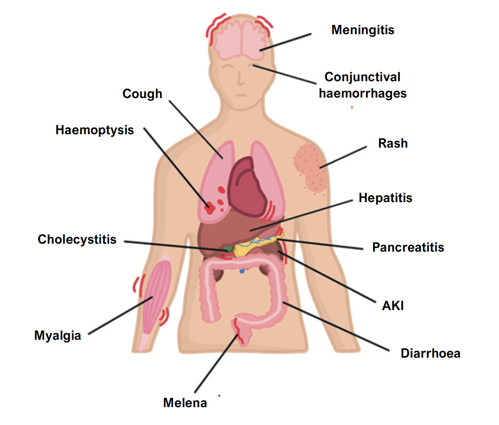 Leptospirosis