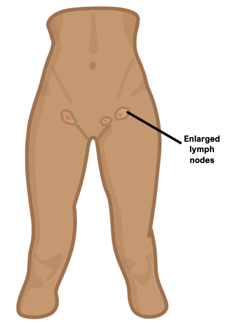Lymphogranuloma venereum
