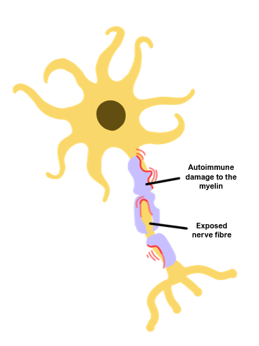 MS Parkinsonian shuffle