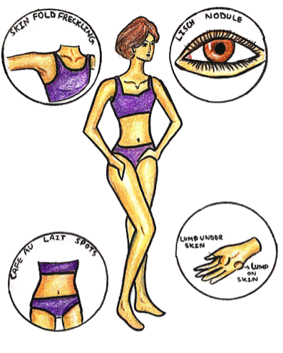 NF1