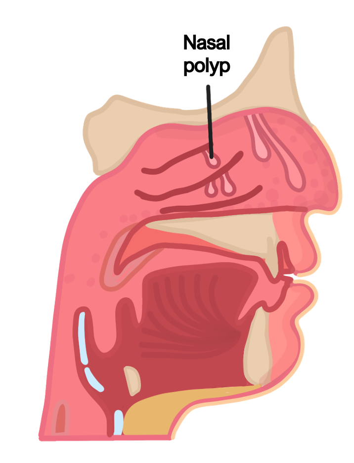 Nasal polyp