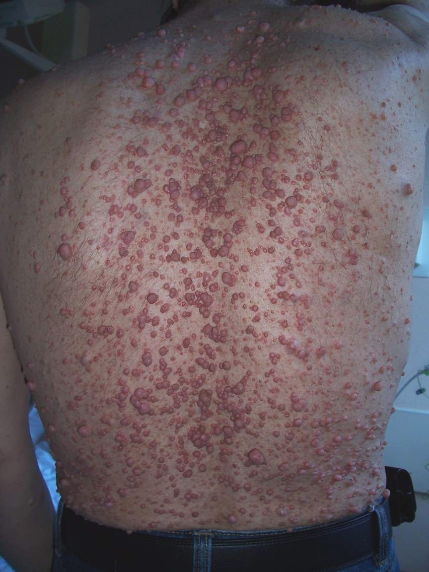 Neurofibroma02