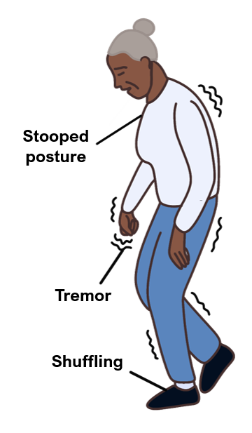 Parkinson's Parkinsonian shuffle
