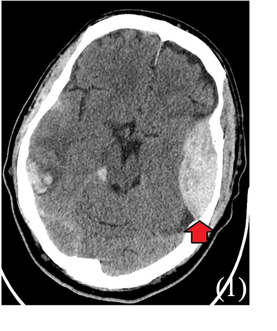 Picture 1 Extradural haematoma
