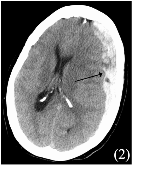 Picture 1 Subdural haematoma