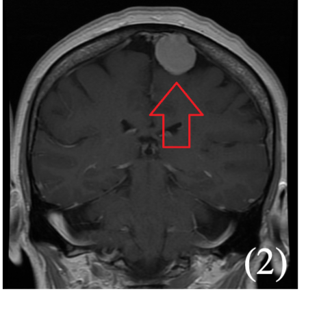 Picture 1 meningioma