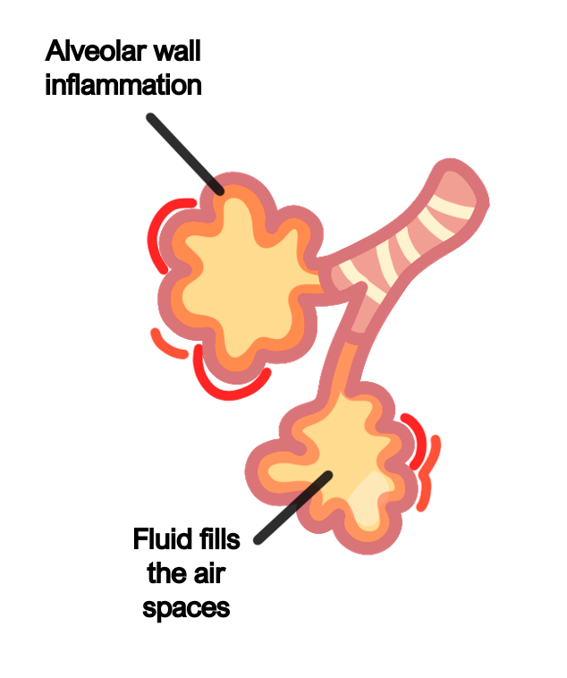 Pneumonia right lobar pneumonia