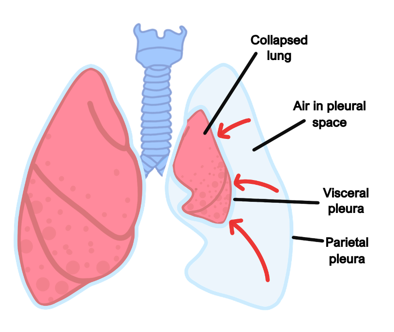 Pneumothorax pneumothorax