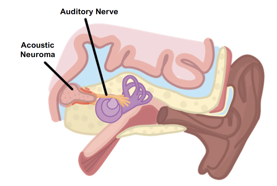 Schwannoma meningioma