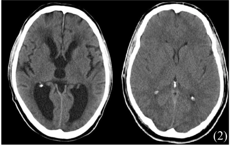 Screenshot 2021-07-23 at 14.19.45 Hydrocephalus