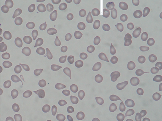 'Tear-drop' Poikilocytes 'Tear-drop' Poikilocytes
