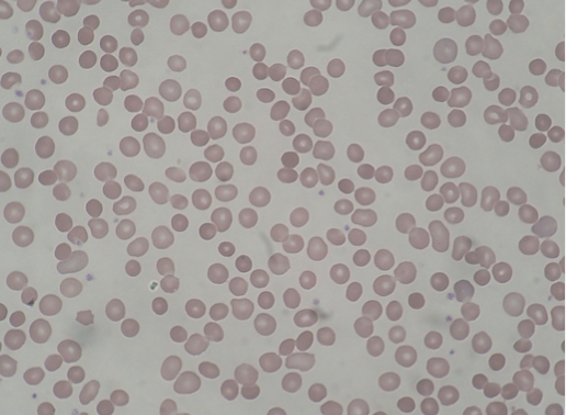 Spherocytes Spherocytes
