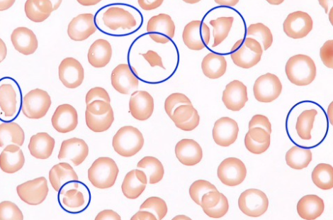 Schistocytes Schistocytes