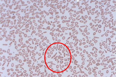 'Pencil' poikilocytes 'Pencil' poikilocytes