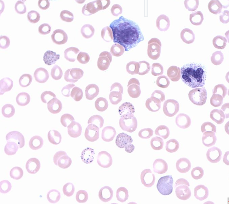 Basophilic stippling Basophilic stippling