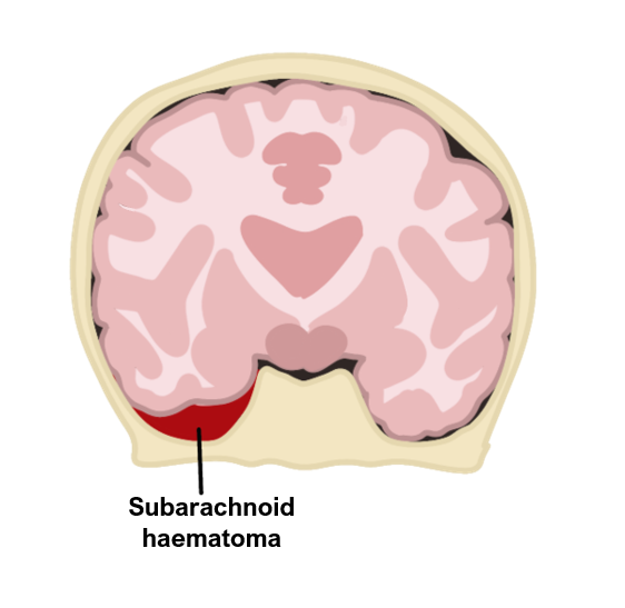 Subarachnoid haematoma Subarachnoid haemorrhage