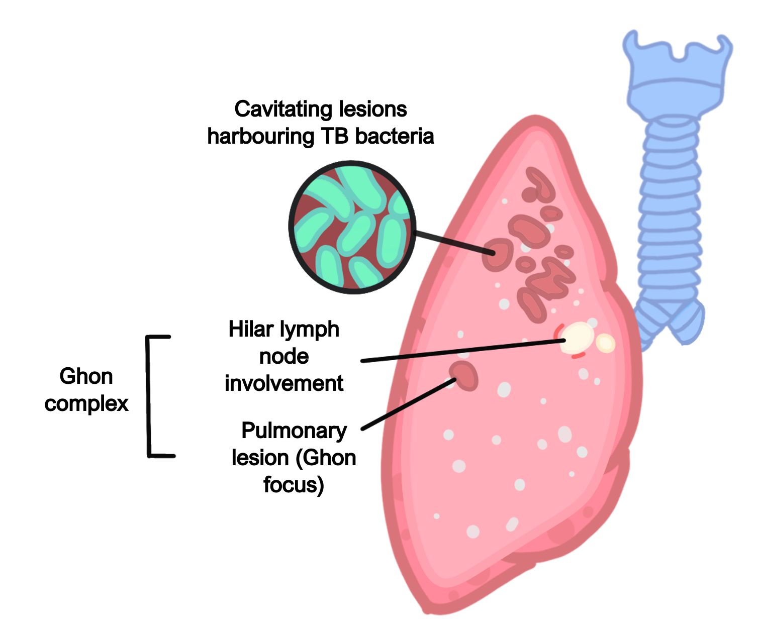 TB right lobar pneumonia