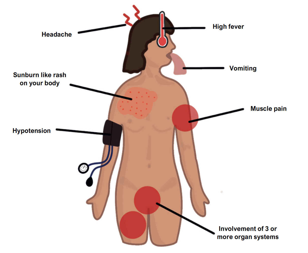 Toxic Shock syndrome