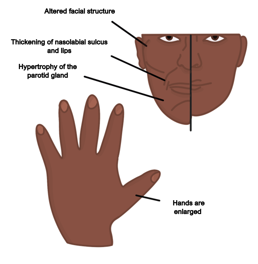 acromegaly