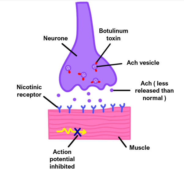 botulism Botulism