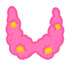 hypoparathyroidism