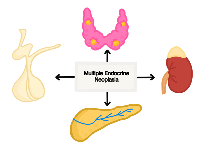 multiple endocrine neoplasia