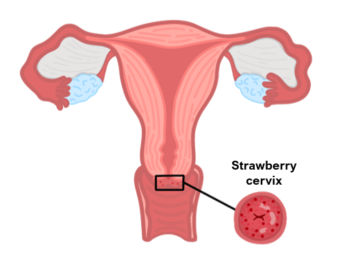 strawberry cervix