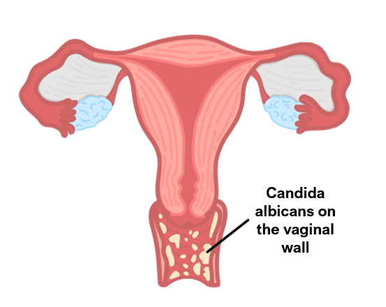 vaginal thrush