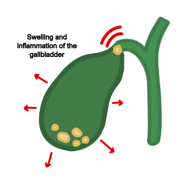 Acute cholecystitis
