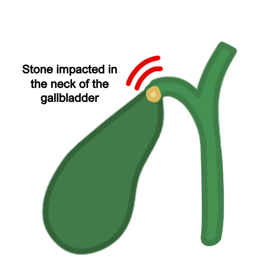 Biliary colic