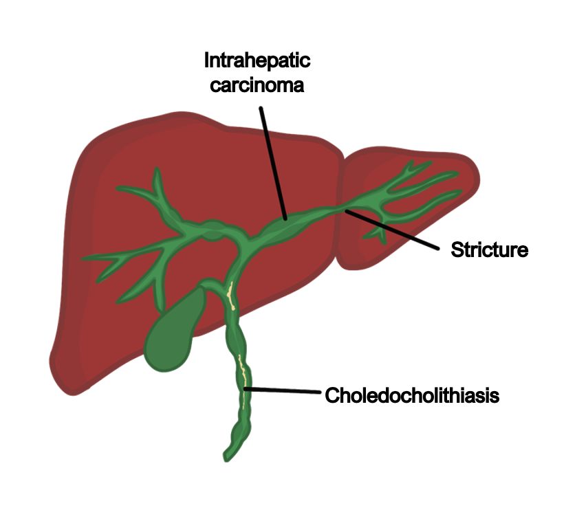 Cholangiocarcinoma