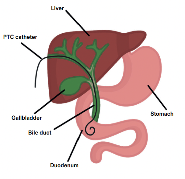 Choledolithiasis