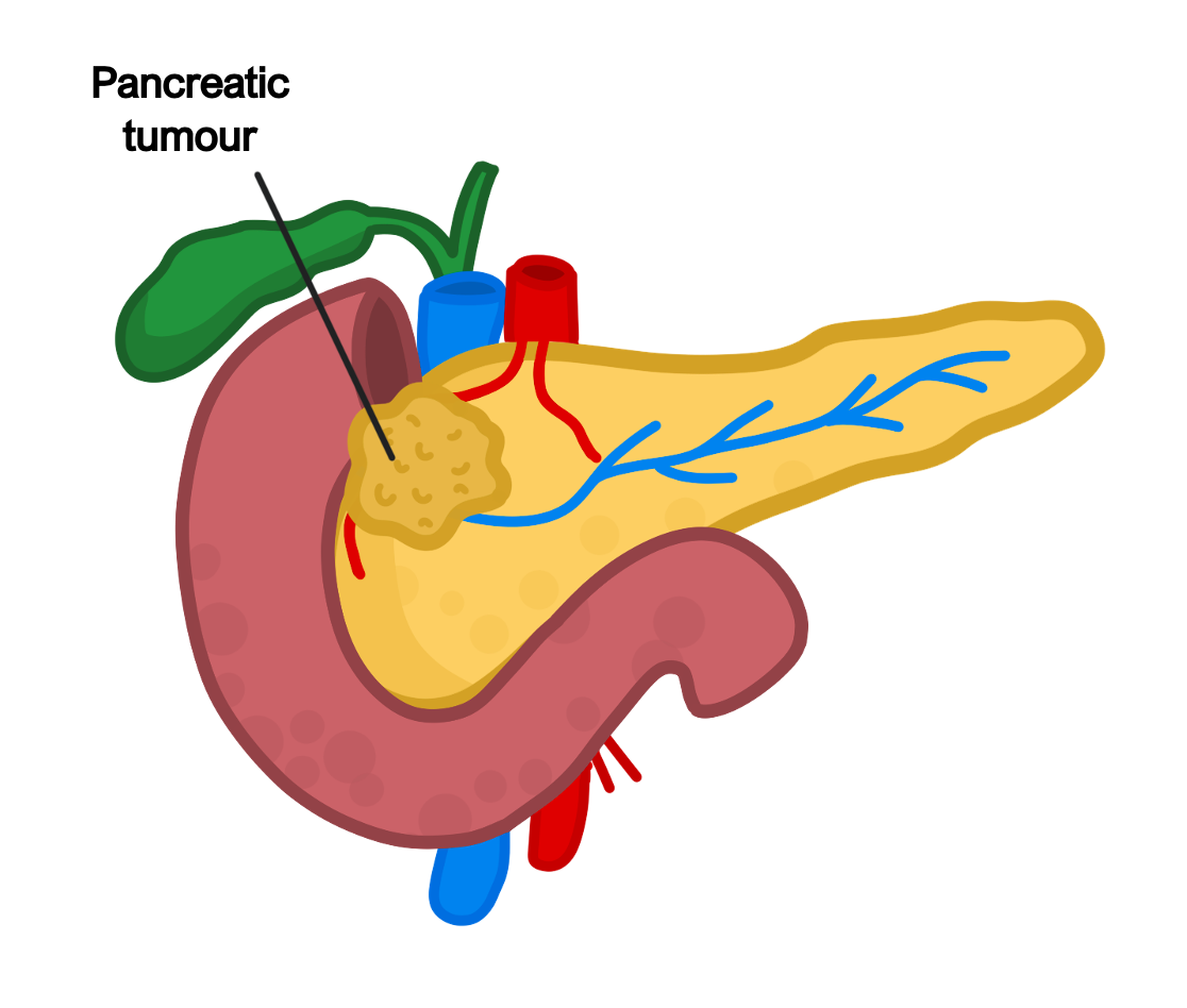 Pancreatic tumour